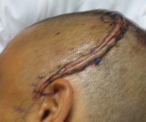 Football Player Head Injury