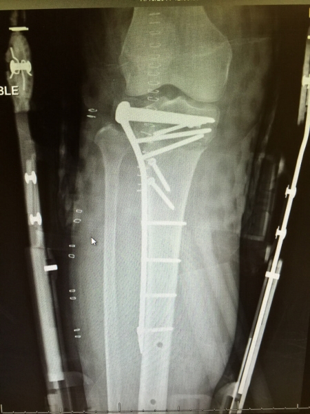X-Ray of Broken Bones From Distracted Driving
